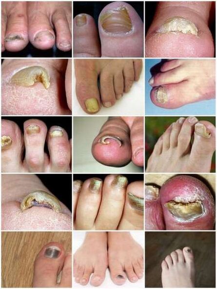 Glivična okužba nohtne plošče