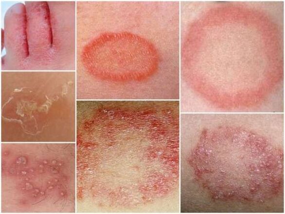 Trichophytosis kože nog