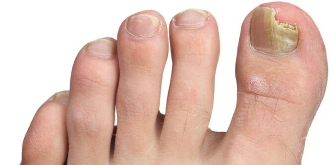 glivična okužba nohtne plošče